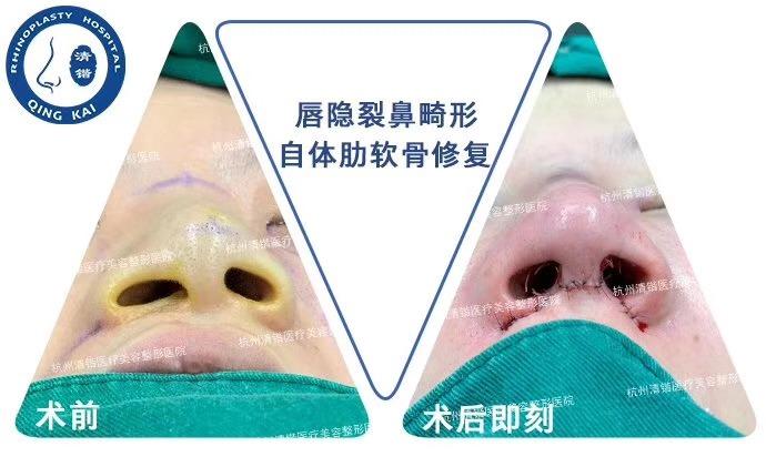 鼻修复