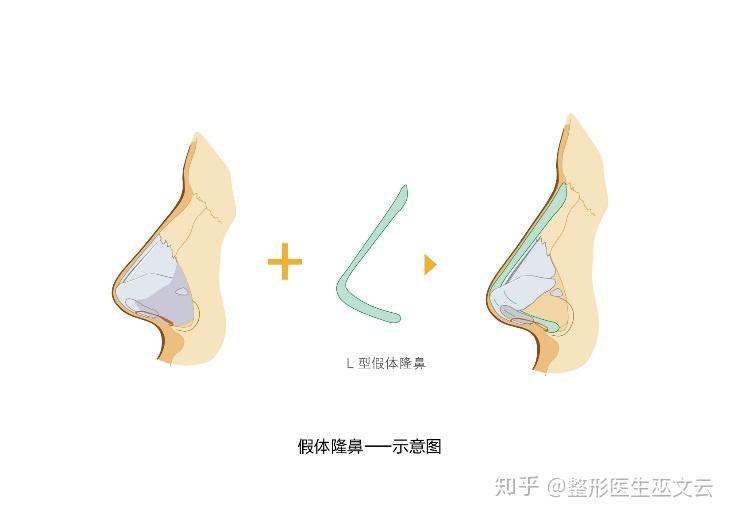 鼻综合手术